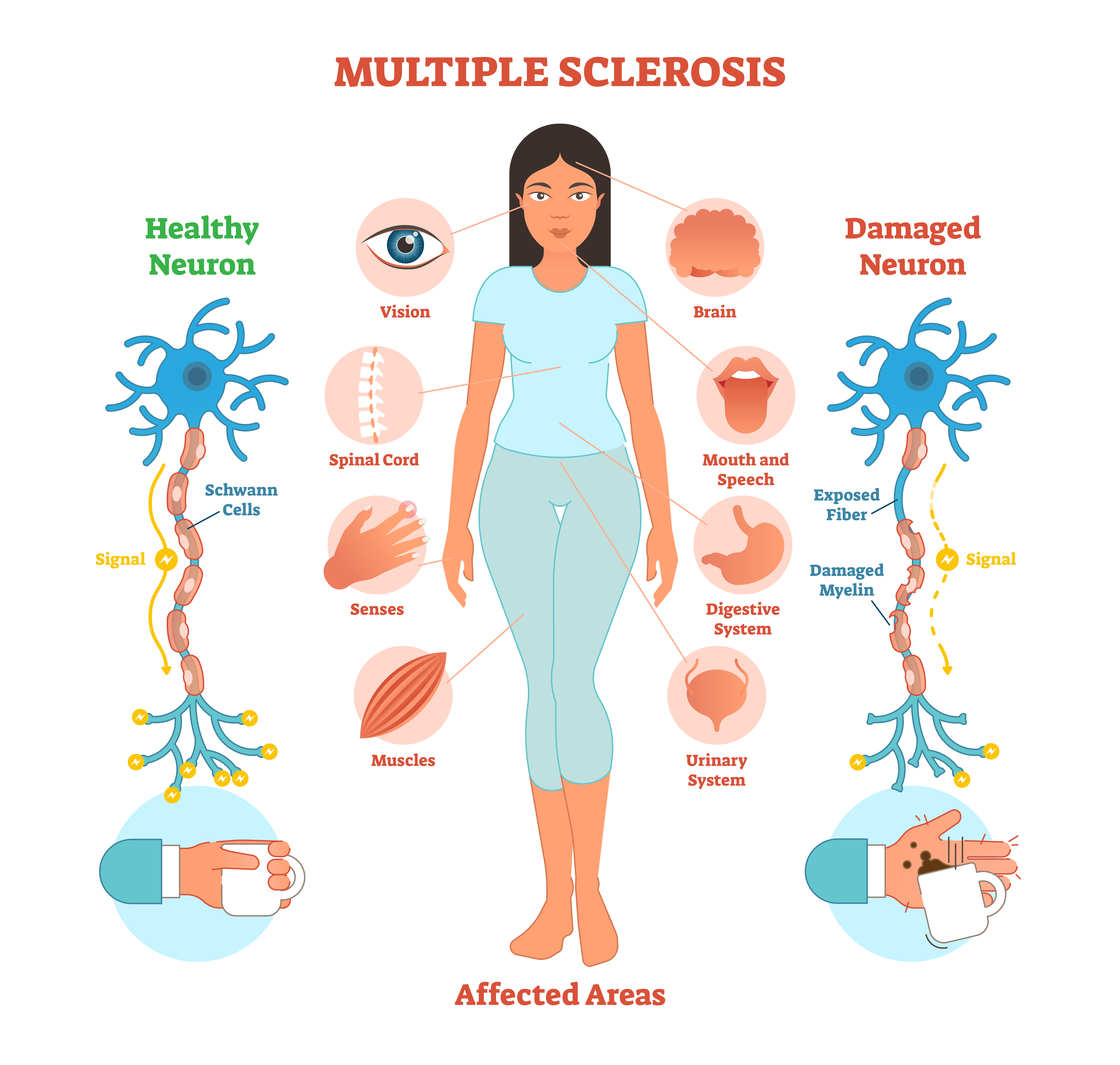 Holistic Treatment of Multiple Sclerosis in New York