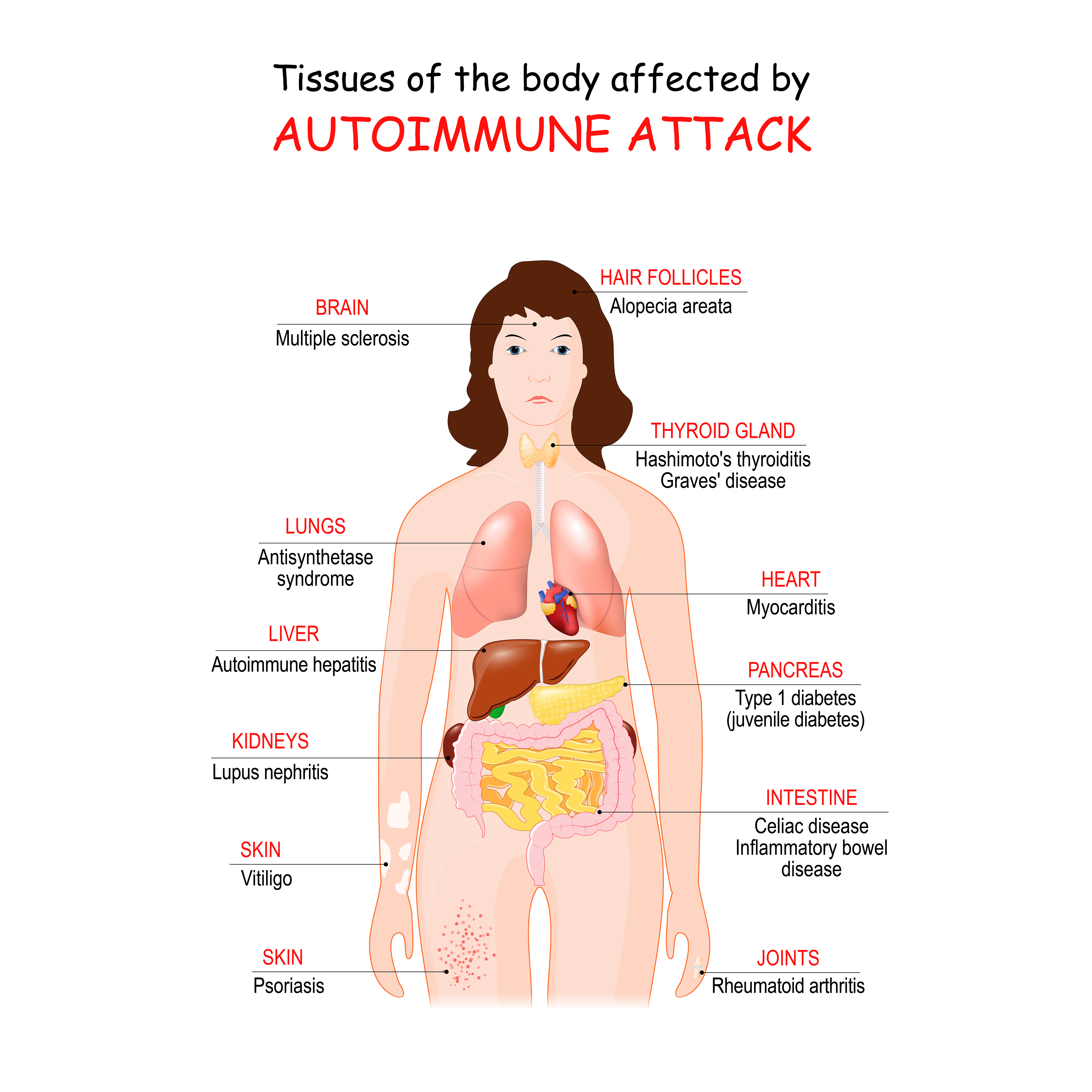 Tissue Body Effects of Autoimmune Disease